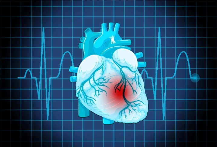 Stiffening of Artery Walls